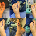 Tightrope Bunin surgery