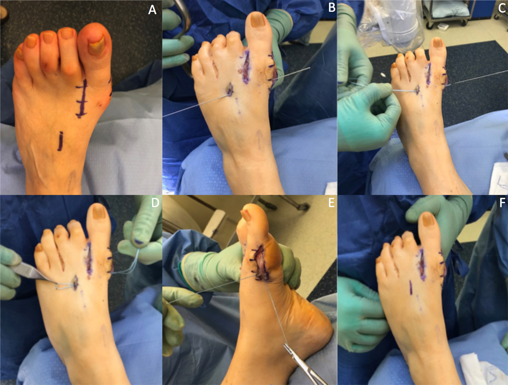 Tightrope Bunin surgery