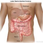 Colon Cancer