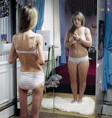 Hypnosis for Body Dysmorphia