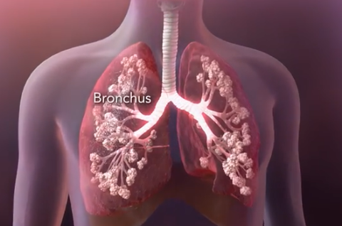 Cystic Fibrosis Homeopathic Treatment