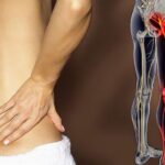 sciatica and lupus