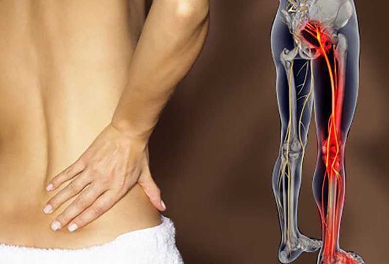 sciatica and lupus